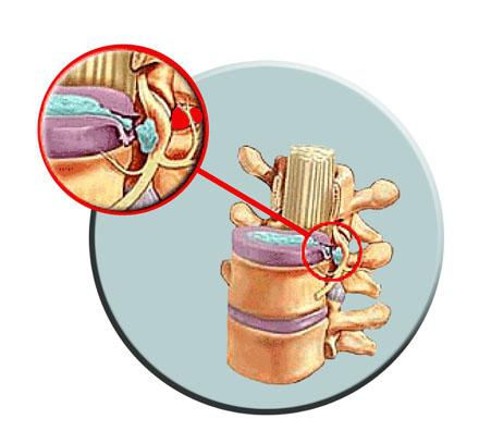 лікування хребетної грижі