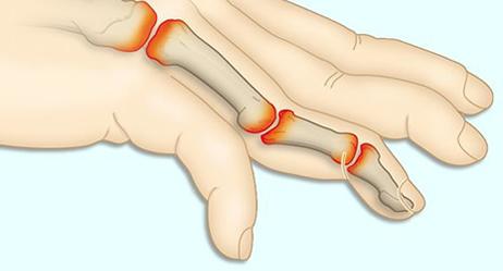 симптоми ревматоїдного артриту