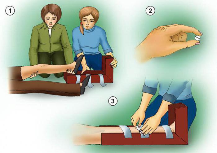 переломи кісток кінцівок перша допомога